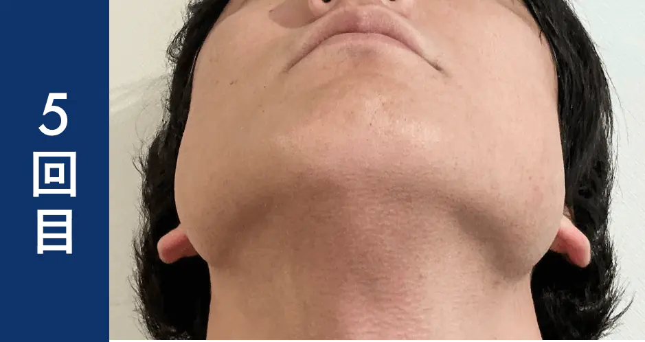 ヒゲ脱毛5回目のレビュー・ビフォーアフター画像