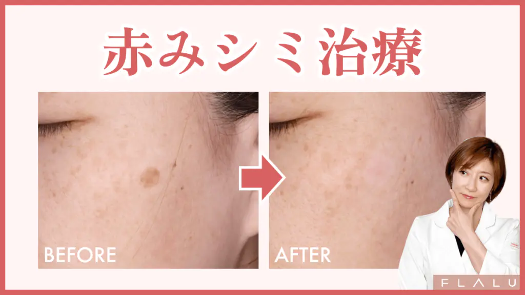 シミ治療をしても消えない人は見て！9割が見逃す“赤みシミ”について医師が解説
