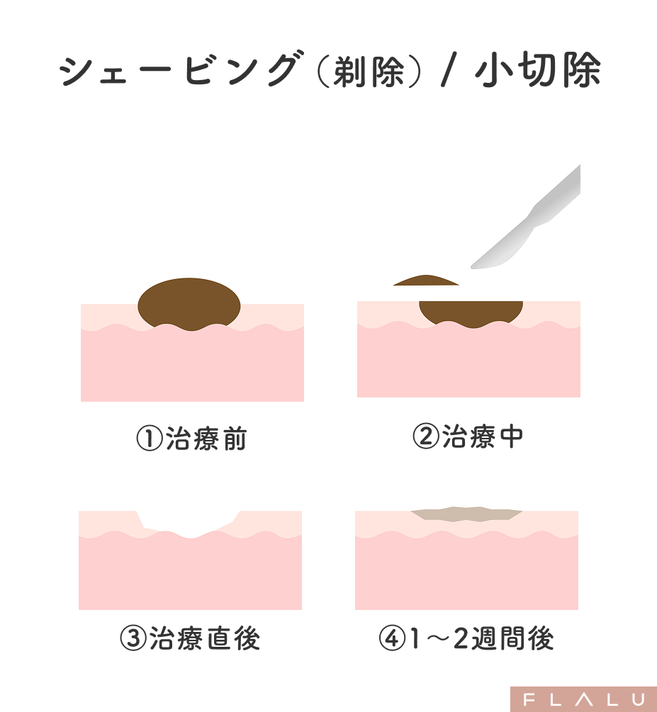 老人性イボ_治療法_ト_小切開