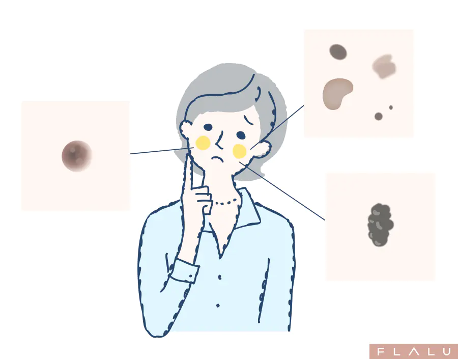 老人性イボ・脂漏性角化症を解説｜顔・首・頭皮・体のイボの原因と治療【医師監修】