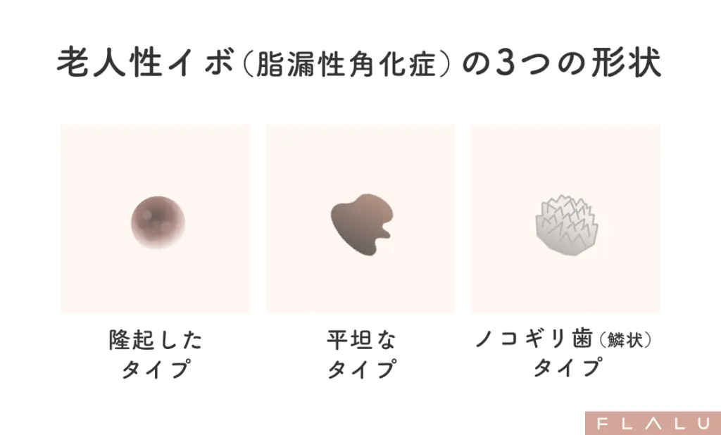 老人性イボ_形状_251106