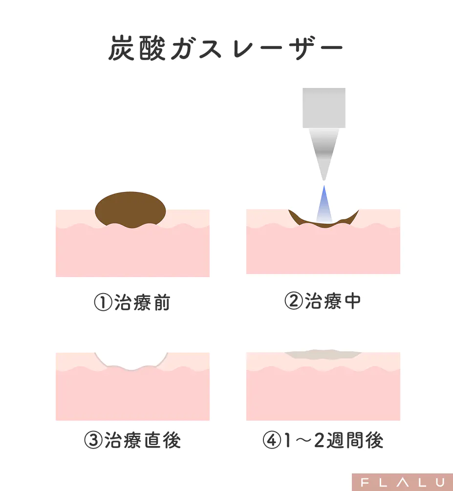 老人性イボ_治療法_炭酸ガスレーザー