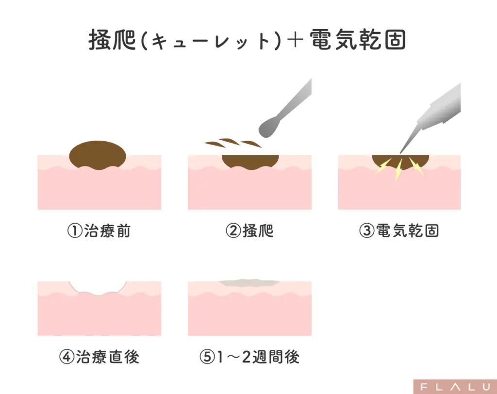 老人性イボ_治療法_キューレット+電気凝固