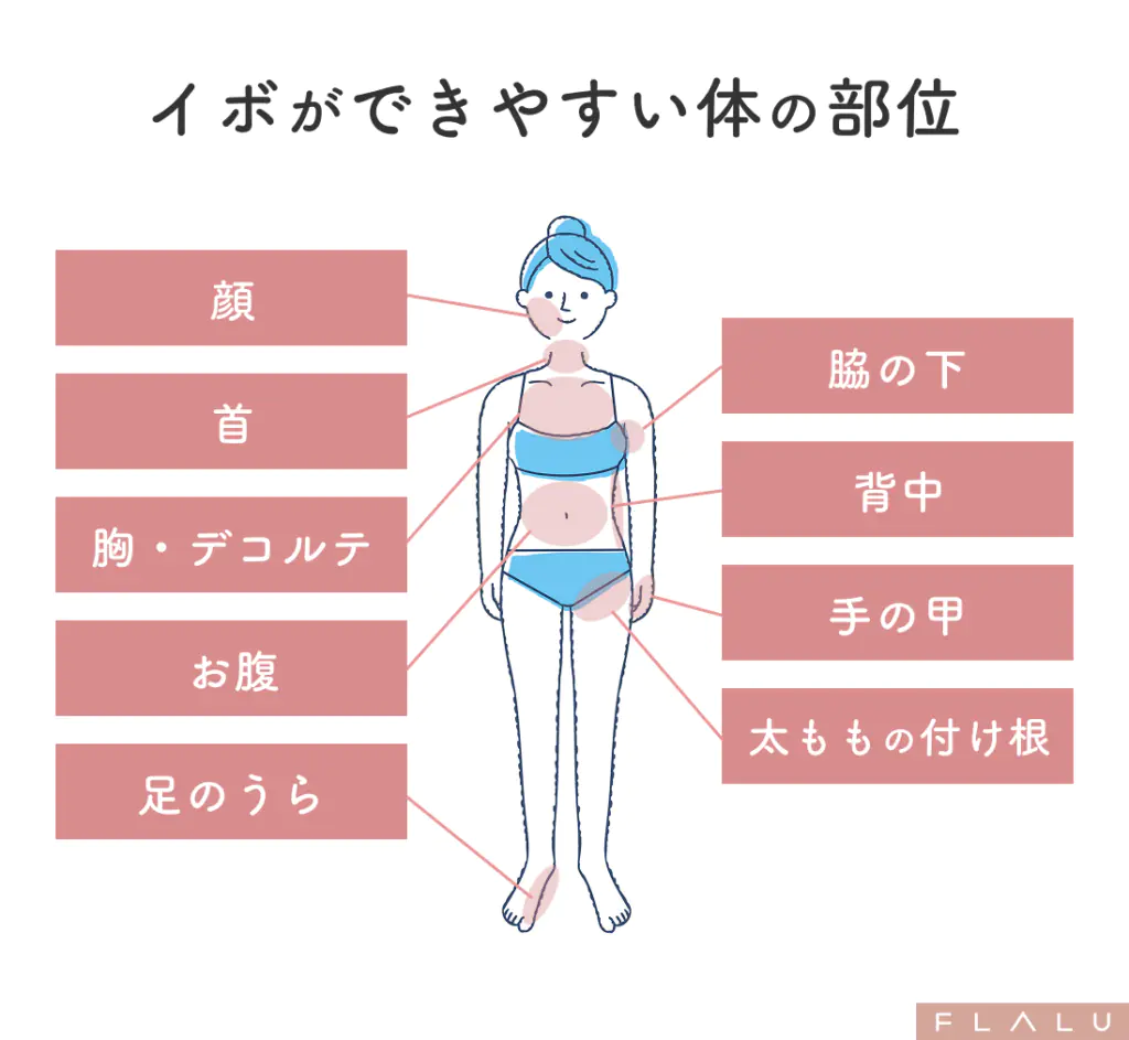 老人性イボ_できやすい部位_251106