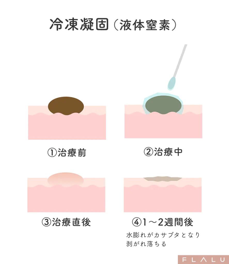 老人性イボ_治療法__小切開